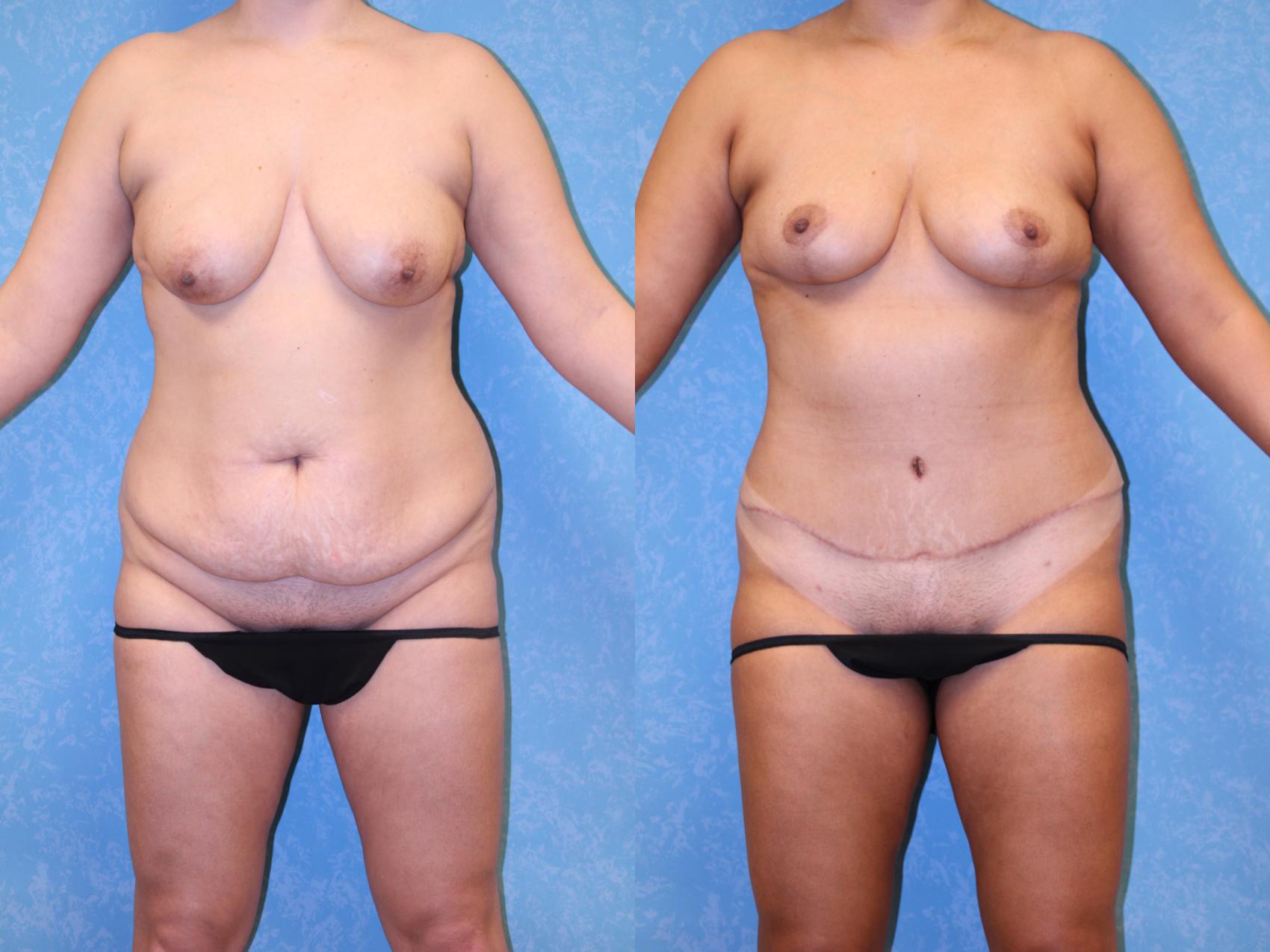 Before & After Mommy Makeover Case 556 Front View in Toledo, Ohio