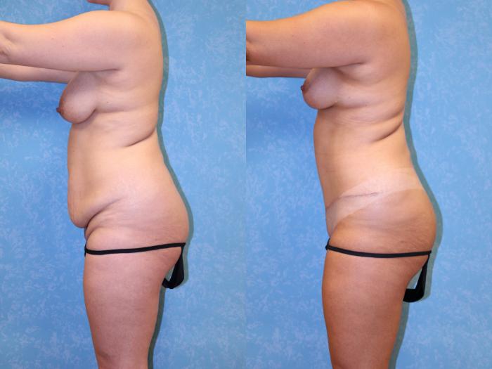 Before & After Mommy Makeover Case 556 Left Side View in Toledo, Ohio