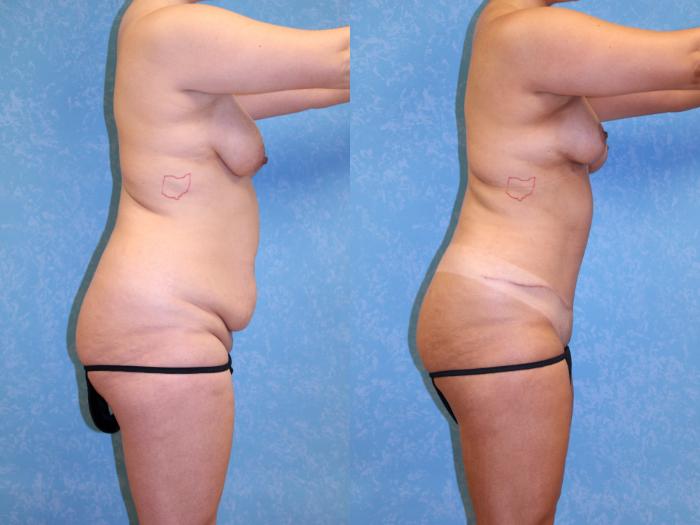 Before & After Mommy Makeover Case 556 Right Side View in Toledo, Ohio