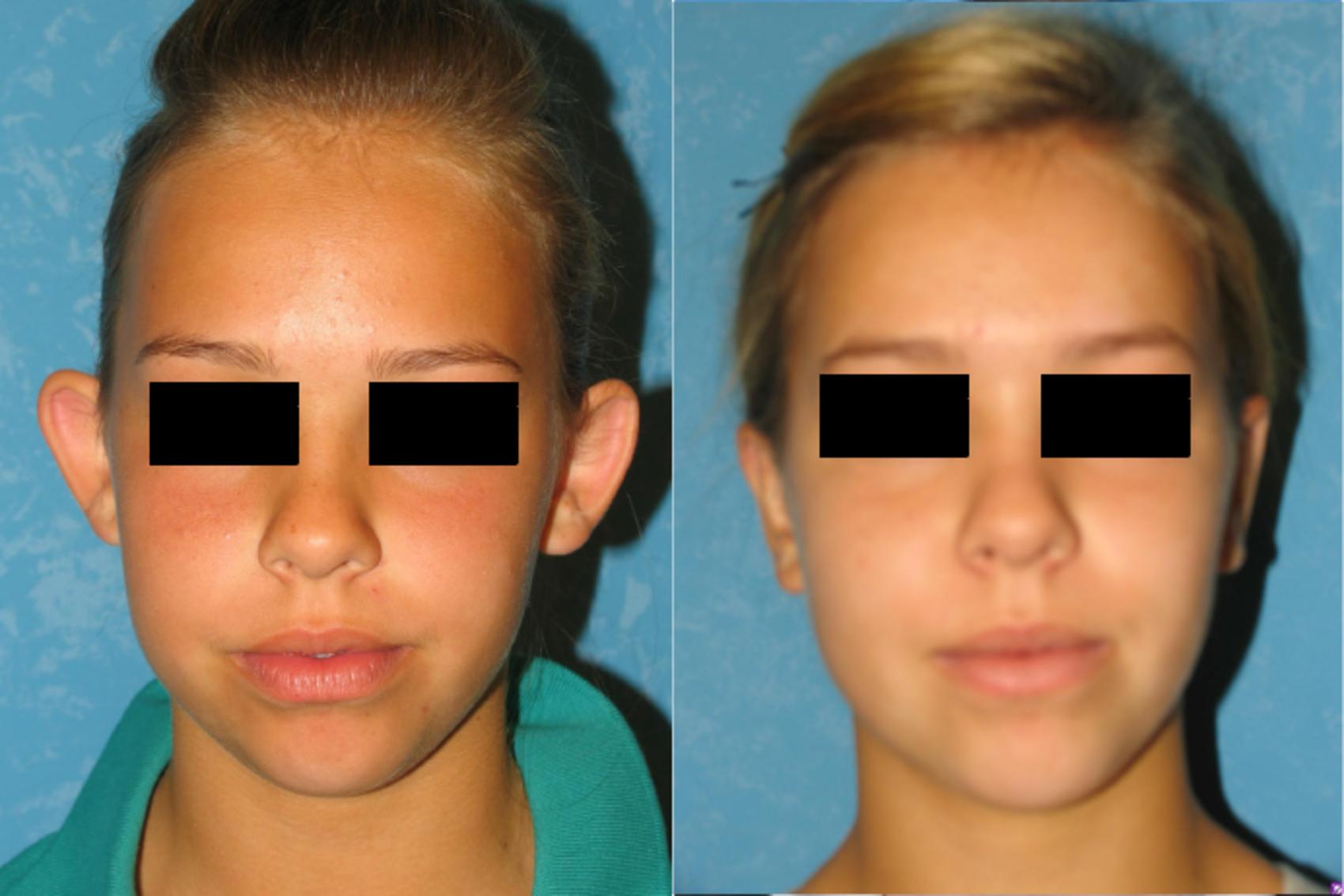 Before & After Otoplasty Case 90 View #1 View in Toledo, Ohio