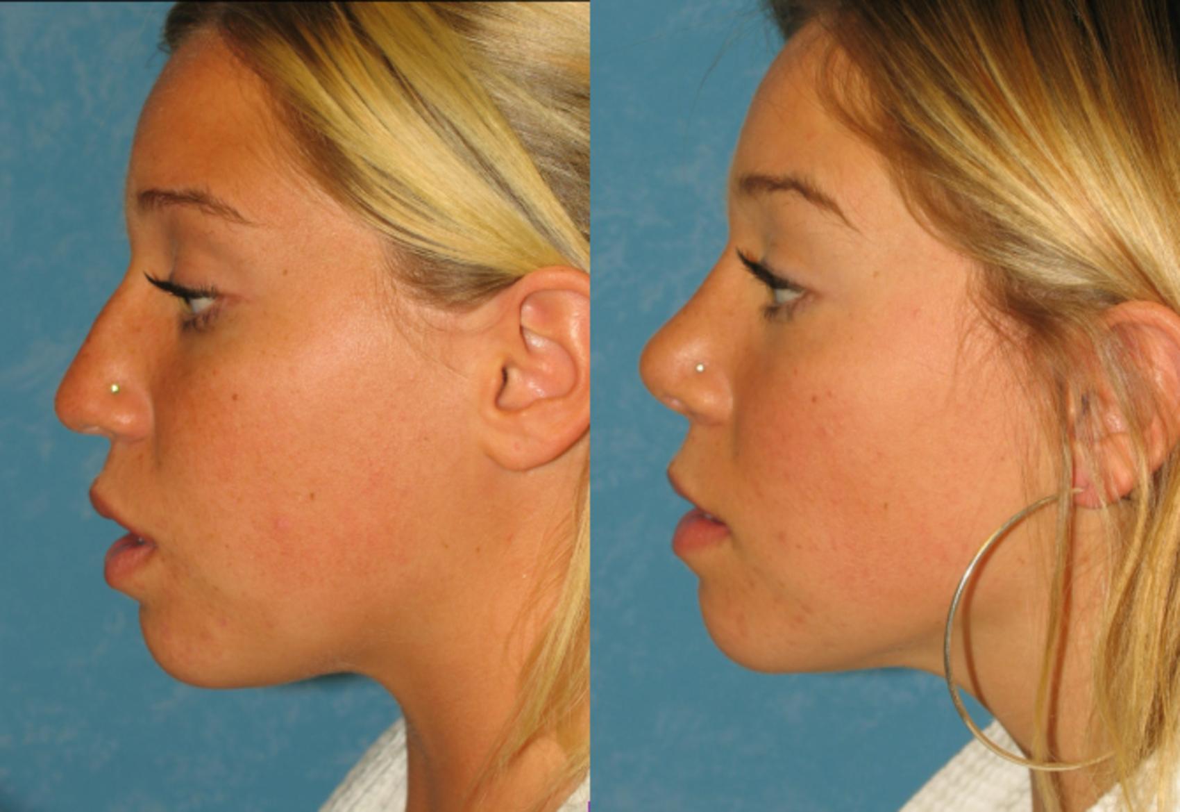 Before & After Rhinoplasty Case 100 View #1 View in Toledo, Ohio