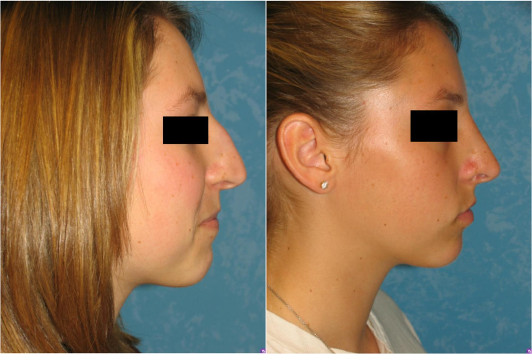Before & After Rhinoplasty Case 105 View #1 View in Toledo, Ohio