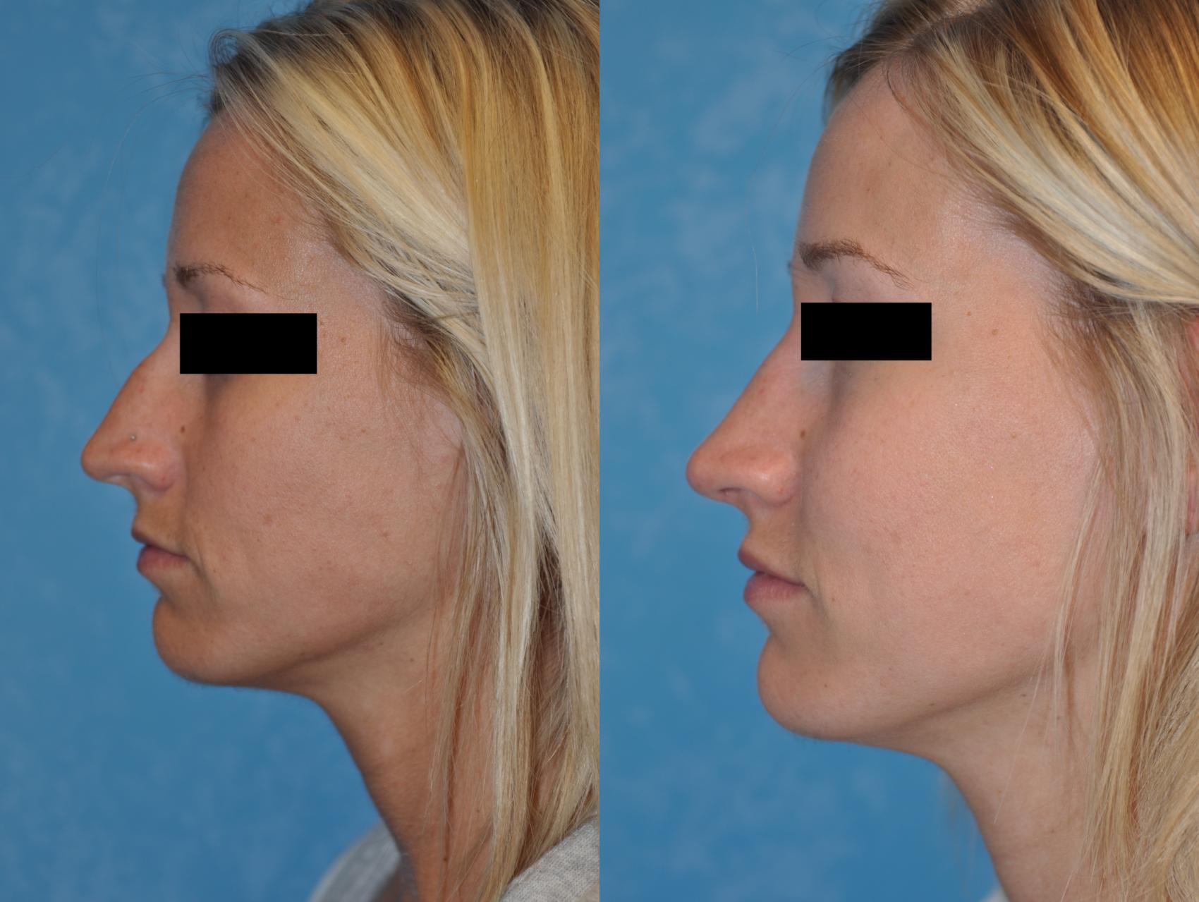 Before & After Rhinoplasty Case 124 View #2 View in Toledo, Ohio
