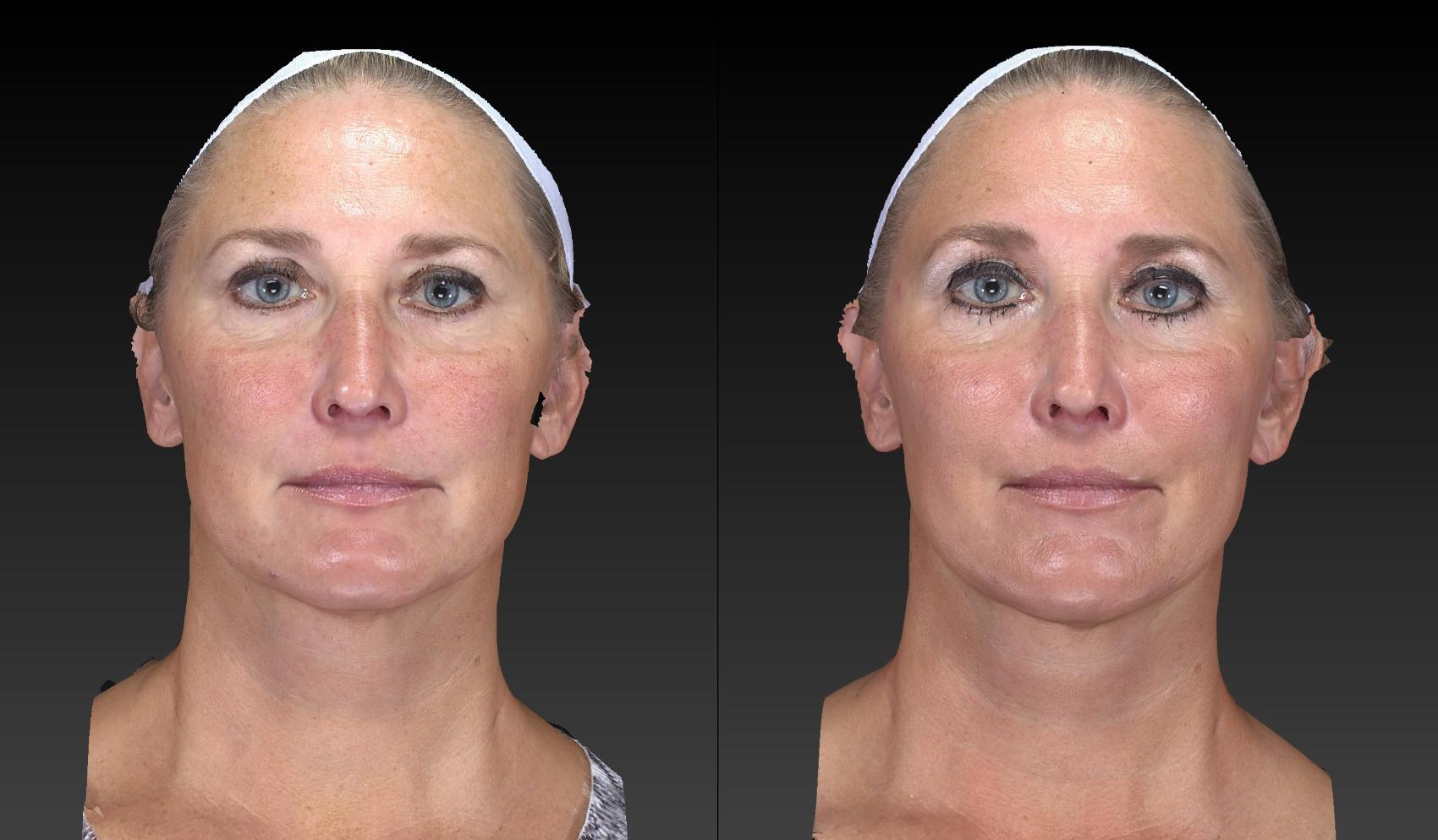 Before & After Ultherapy Case 209 View #1 View in Toledo, Ohio